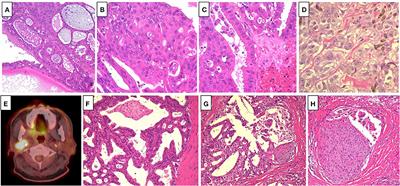 Case Report: Complete Response of Recurrent and Metastatic Cystadenocarcinoma of the Parotid Gland With a Single Course of Combined Nivolumab and Ipilimumab Therapy